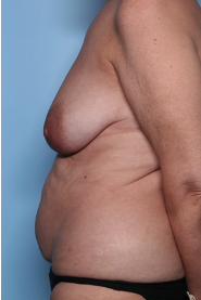 Mommy Makeover Before & After Patient #34313